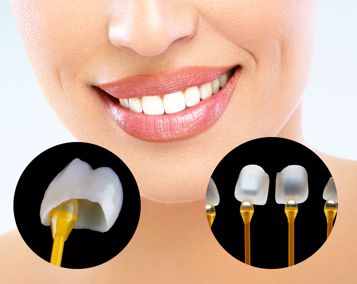 Dental Crowns versus Dental Veneers